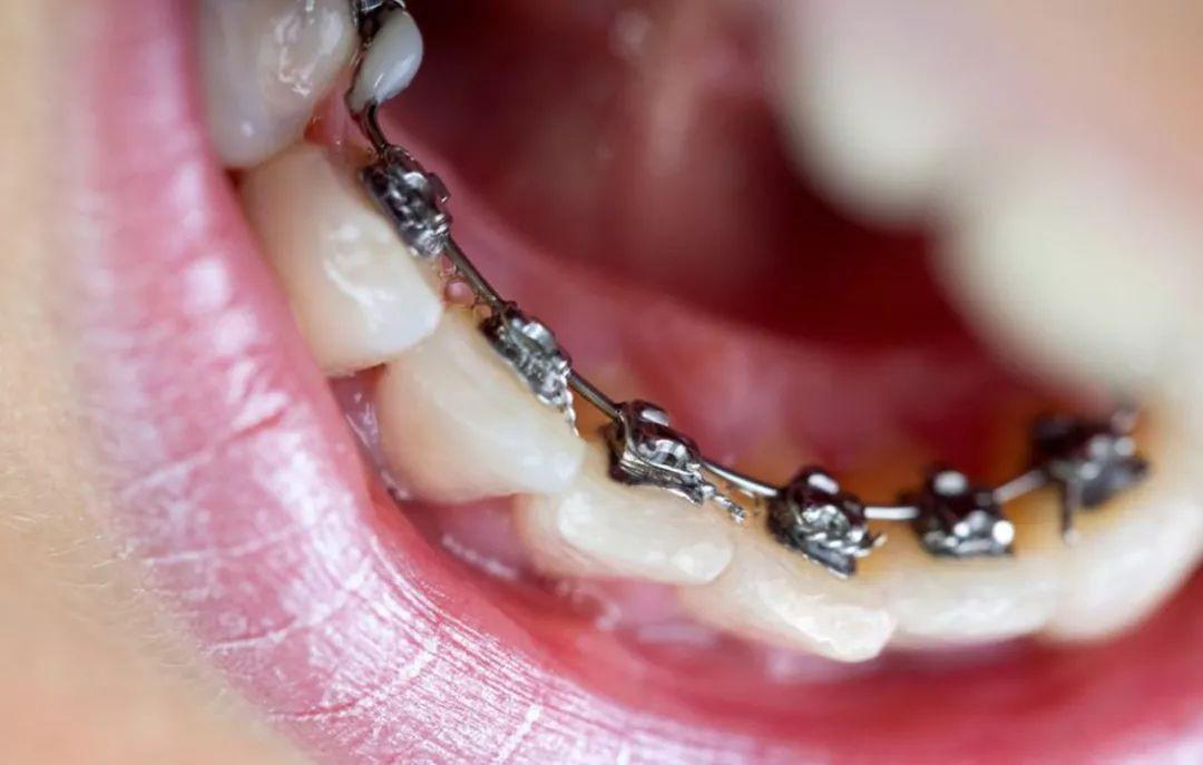 厦门牙齿矫正后保持器要戴多久